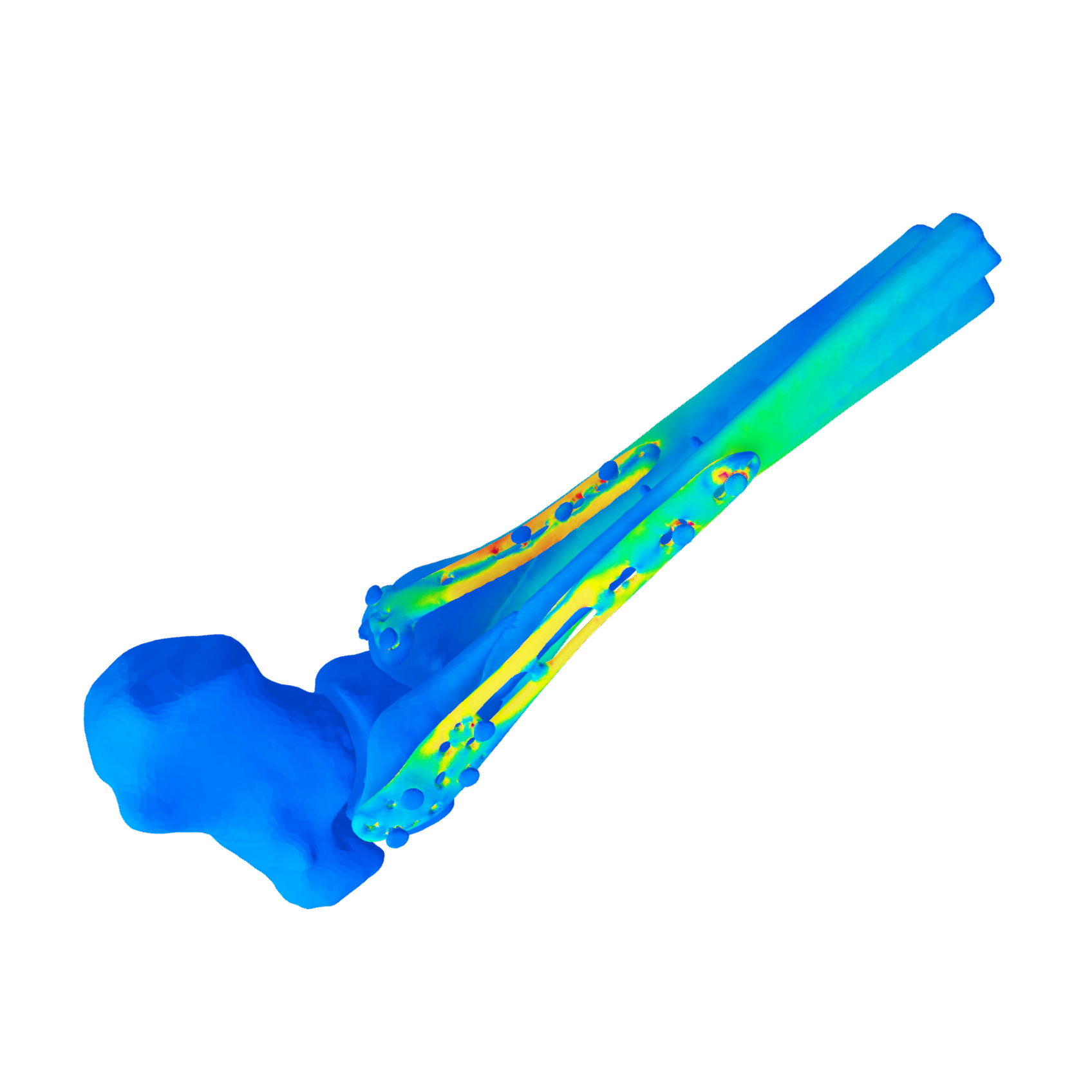 Orthopaedic surgery planning